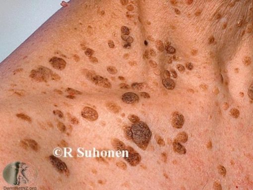 Everything You Need To Know About Benign Skin Lesions Geelong Veins
