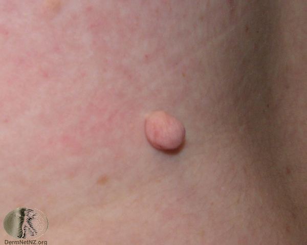 papilloma skin dermnet