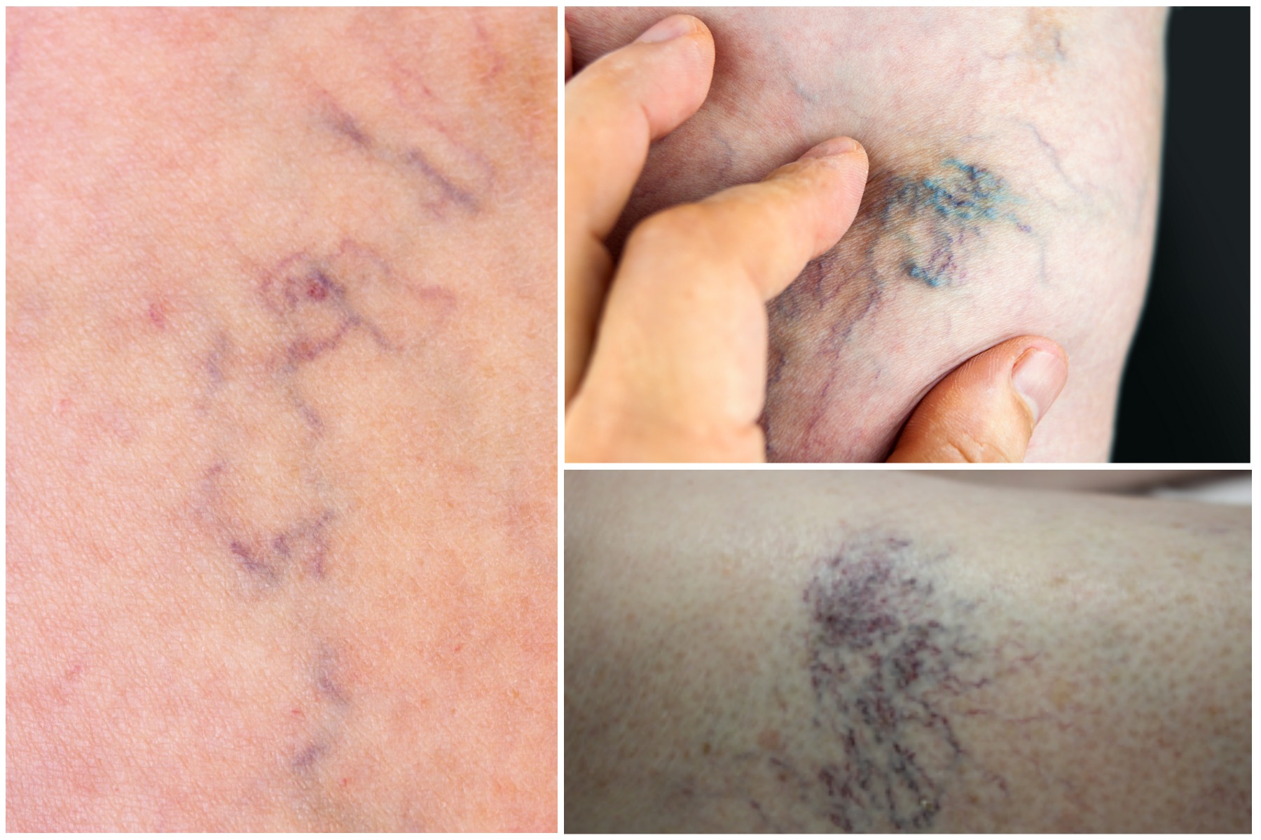 Everything you need to know about spider veins from a doctor who has treated thousands of them