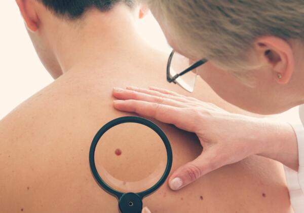 5-things-you-need-to-know-about-skin-cancer-checks