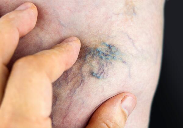 Laser-or-injections-for-spider-veins