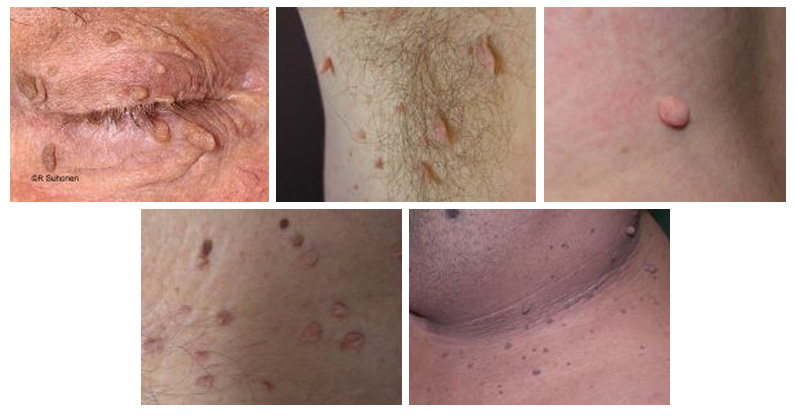 Examples of Skin Tags