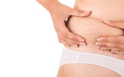 Stretch mark removal treatment options