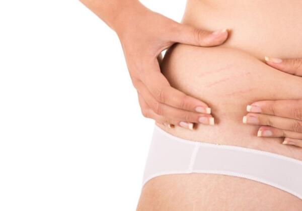 Stretchmarks