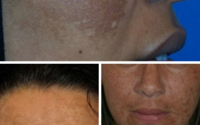 What is MELASMA? How can you treat MELASMA?
