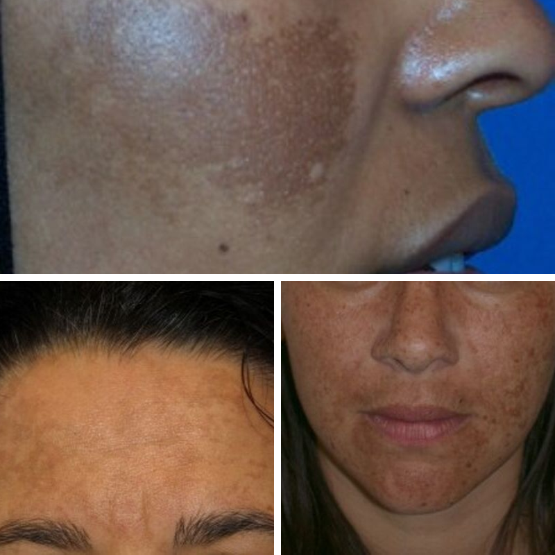 What is MELASMA? How can you treat MELASMA? Geelong Veins Skin and Laser