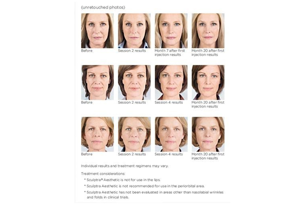 sculptra-aesthetic