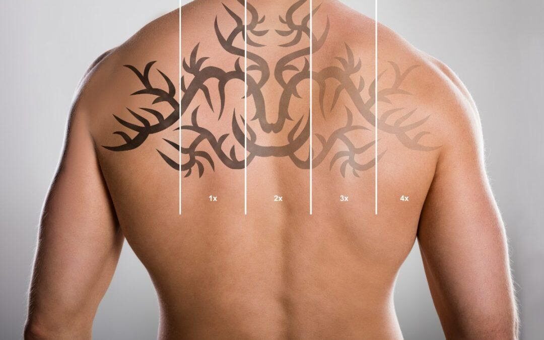Laser Tattoo Removal - Geelong Veins Skin and Laser