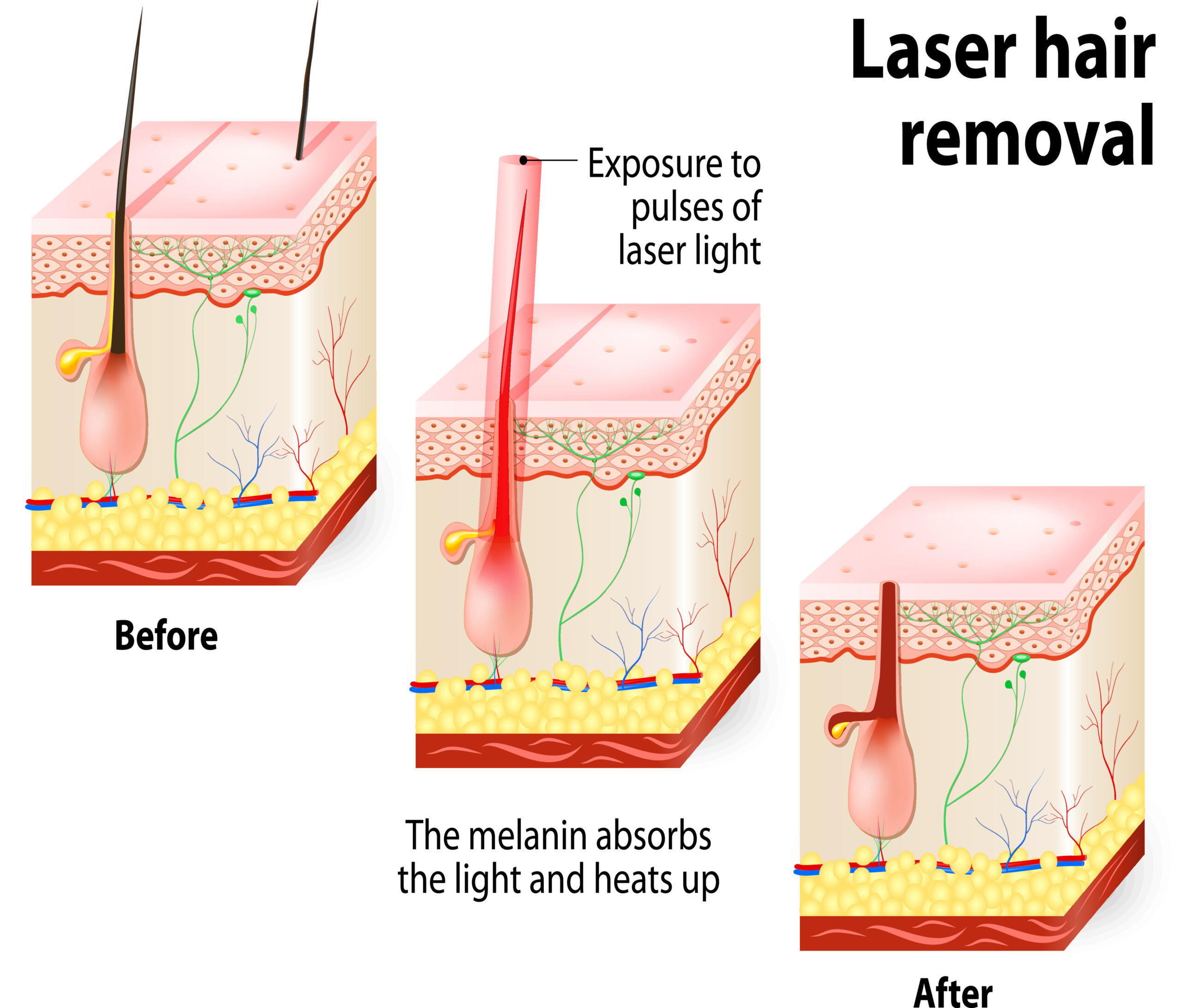 Laser hair removal. Vector diagram - Geelong Veins Skin and Laser