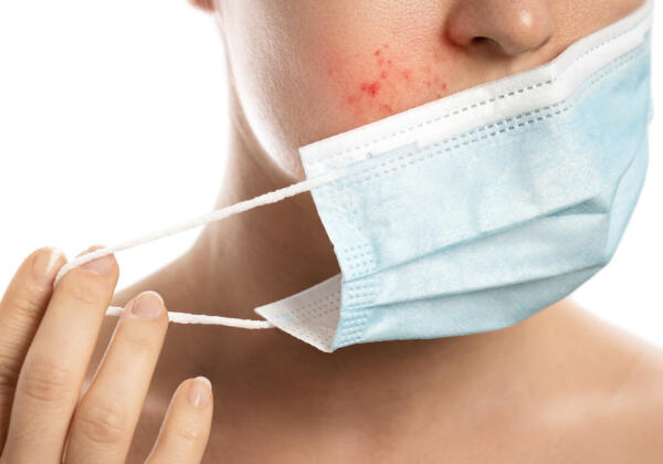 Is-your-face-mask-causing-acne