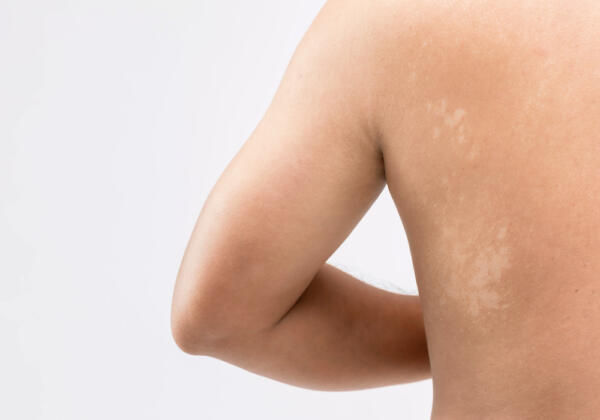 Pityriasis-alba