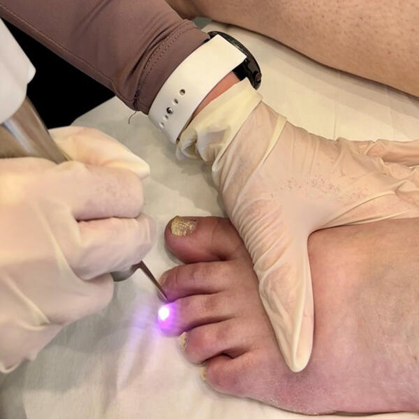 Fungal nail laser treatment by Geelong Vein Skin & Laser