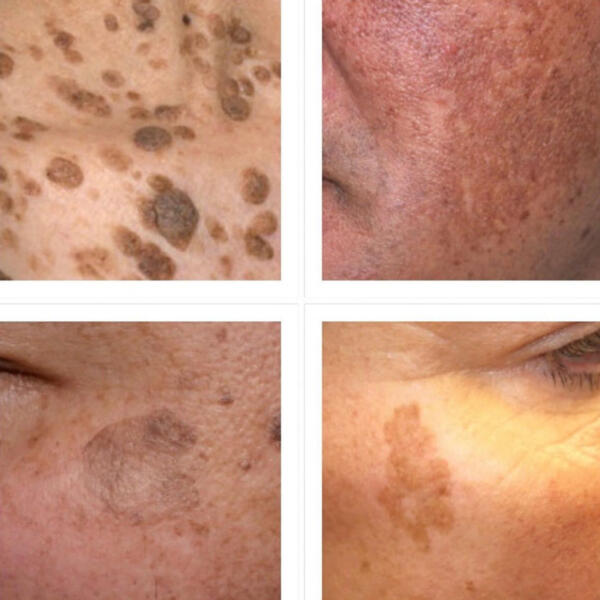 Mole & Brown Spot Removal by Geelong Veins Skin & Laser