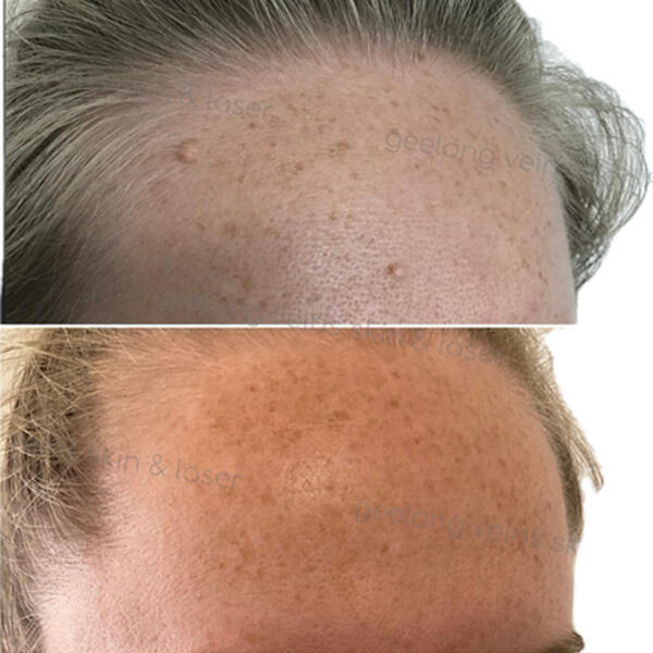 Mole and brown spot removal