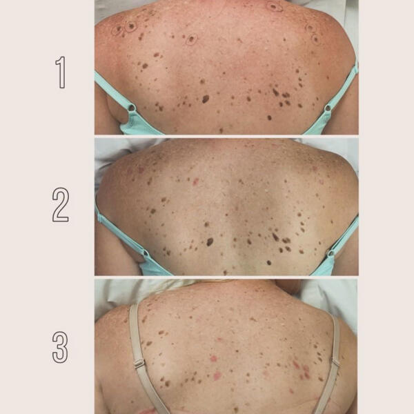 Mole & Brown Spot Removal by Geelong Veins Skin & Laser