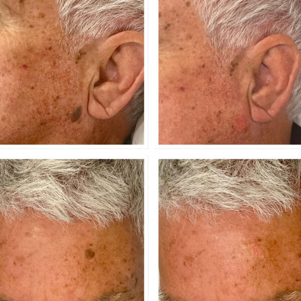 Mole & Brown Spot Removal by Geelong Veins Skin & Laser