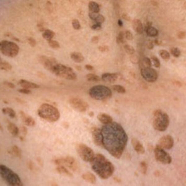 Mole removal by Geelong Veins Skin & Laser