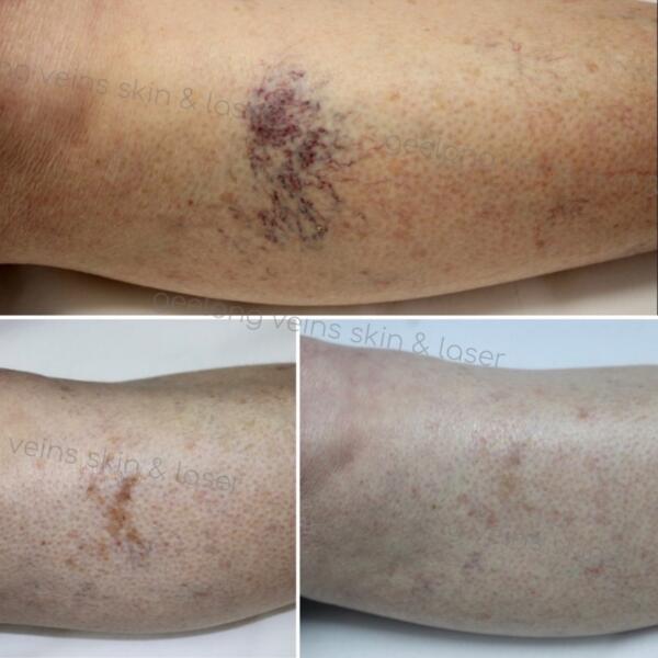 Spider & Surface Vein Treatment