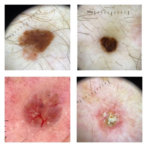 Skin lesion excision