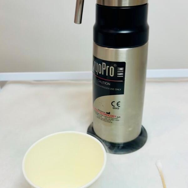 Liquid nitrogen - cryotherapy