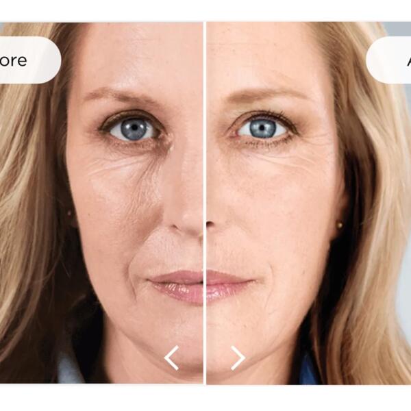 Before and after biostimulating injectables