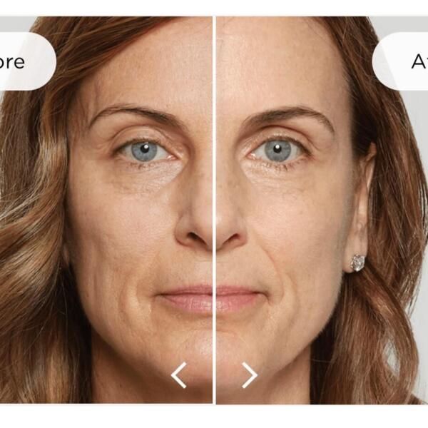 Before and after biostimulating injectables