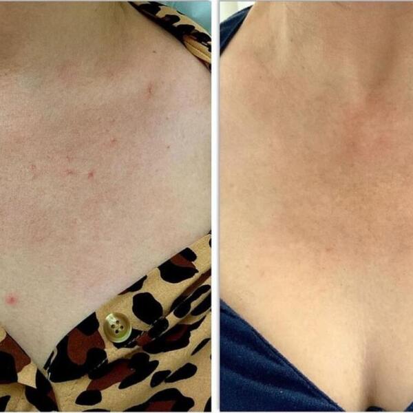 Vascular laser treatment by Geelong Veins Skin & Laser