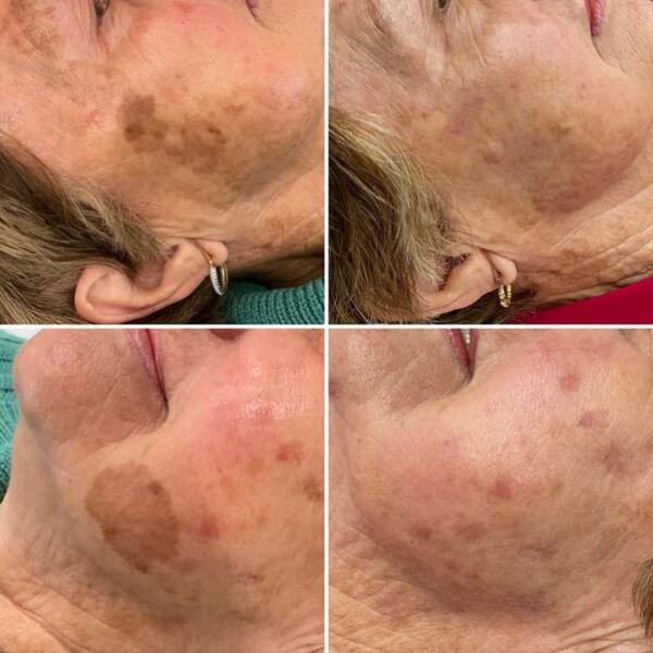 Laser treatment by Geelong Veins Skin & Laser
