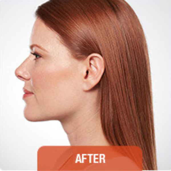 After double chin treatment