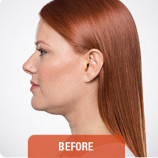 Before double chin treatment