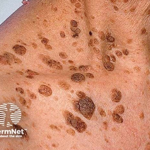 Seborrheic Keratoses Geelong Veins Skin Laser