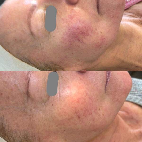 Before and after BBL treatments by Geelong Veins Skin & Laser