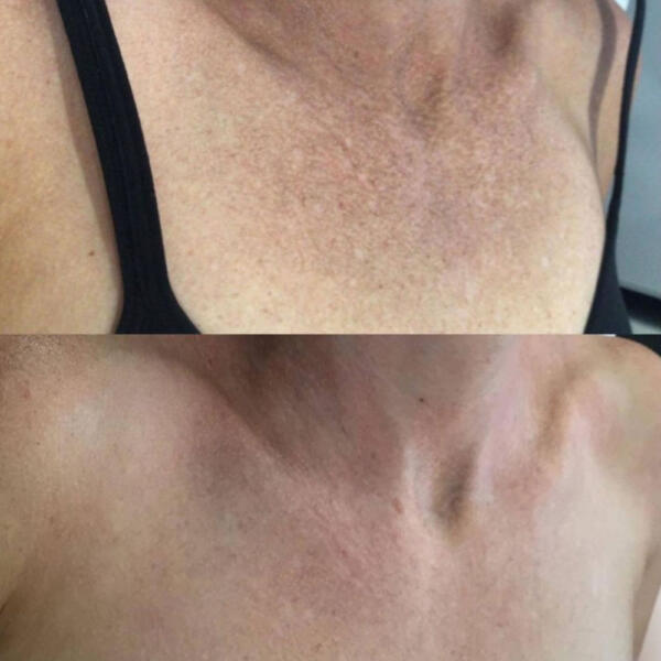 Before and after BBL treatments by Geelong Veins Skin & Laser
