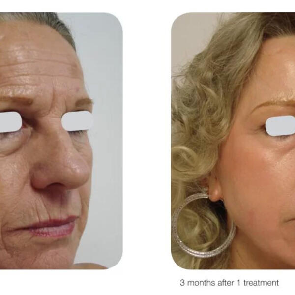 Fractional CO2 laser resurfacing treatment by Geelong Veins Skin & Laser