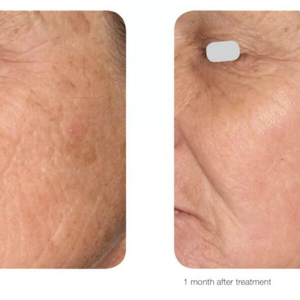 Fractional CO2 laser resurfacing treatment by Geelong Veins Skin & Laser