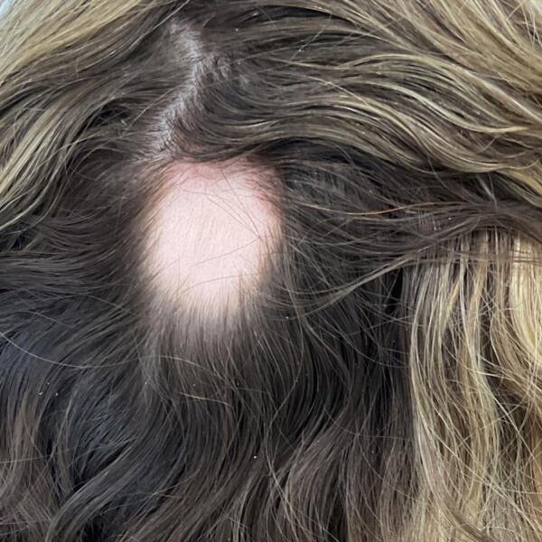 Alopecia treatment by Geelong Veins Skin & Laser