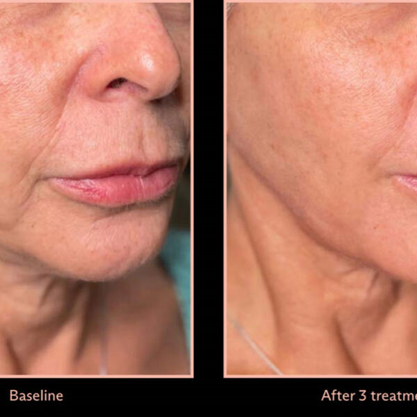 Chin shaping by Geelong Veins Skin & Laser