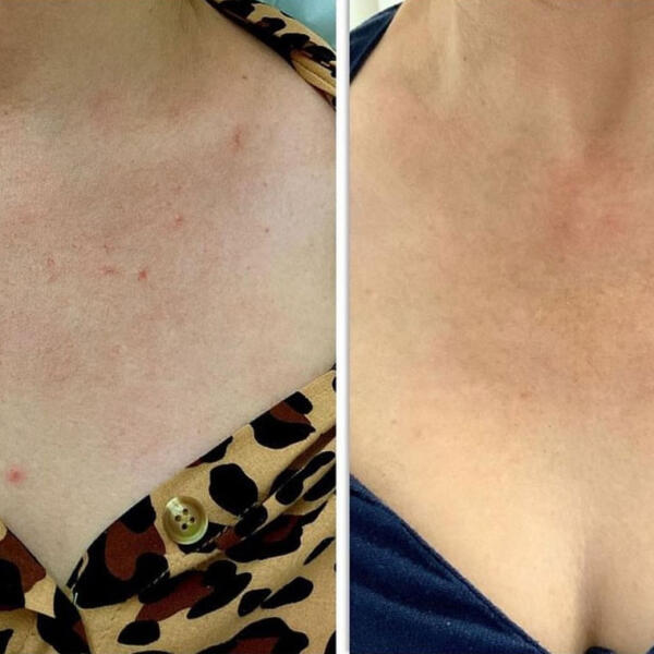 Vascular laser treatment by Geelong Veins Skin & Laser