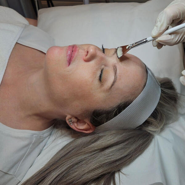 Skin peels by Geelong Veins Skin & Laser