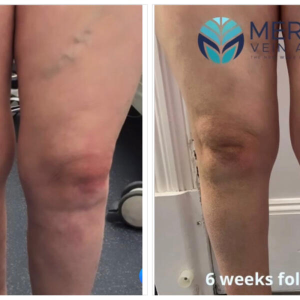 Varicose vein treatments by Geelong Veins Skin & Laser