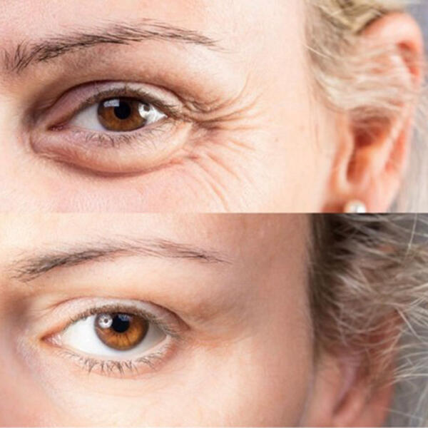 Before and after wrinkles treatment by Geelong Veins Skin & Laser