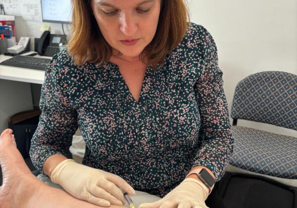 Spider Vein Injection By Doctor Barbra Ward