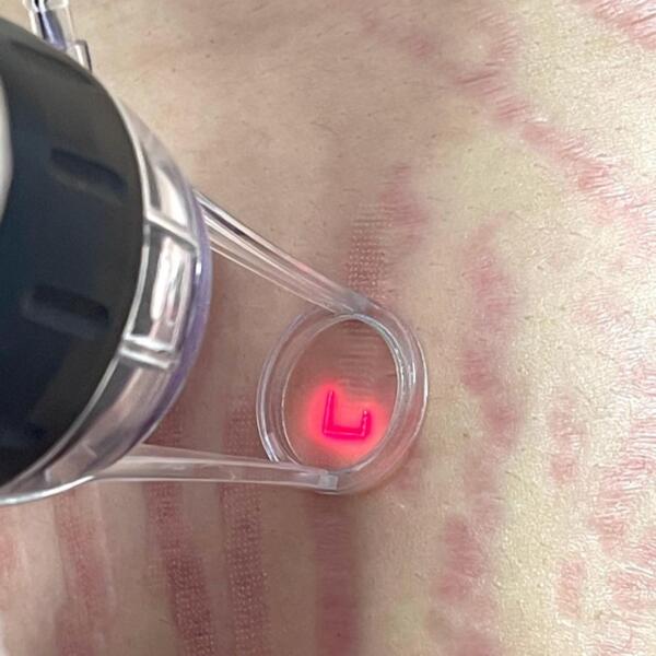 Acupulse.stretchmarks