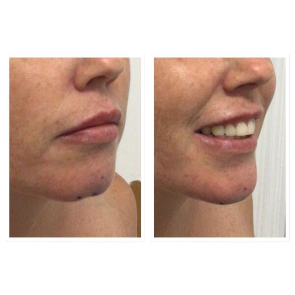 Chin Filler
