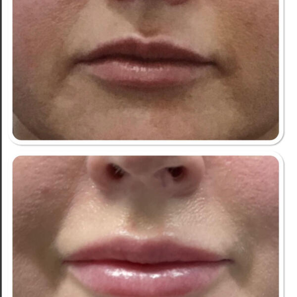 Filler Lips