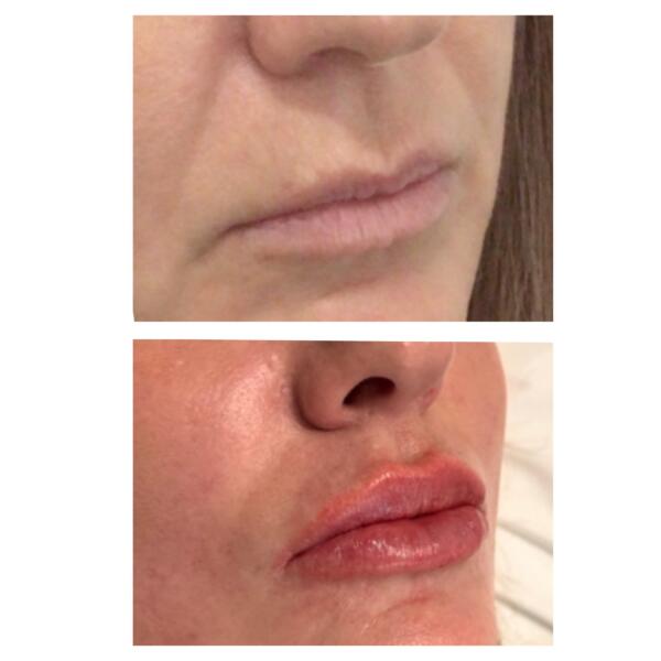 Lip Filler Before-after 3yrs Apart