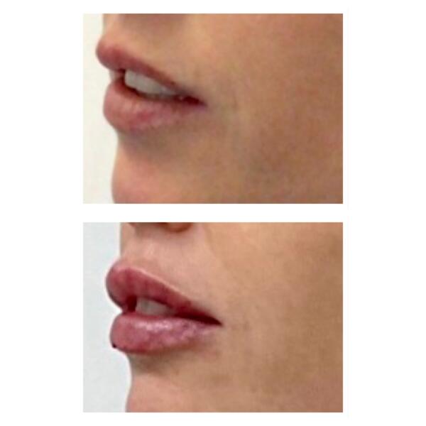 Lip Filler2