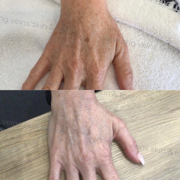 Pigment Laser Hand
