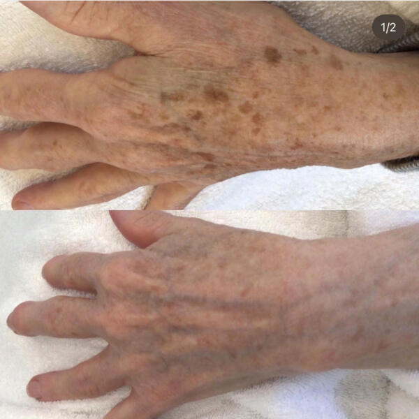 Pigment Laser Hands