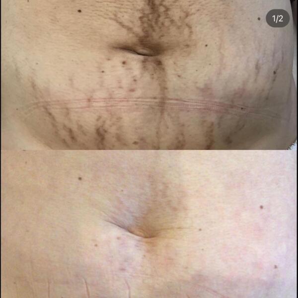 Stretchmarks